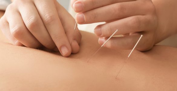 Akupunktur