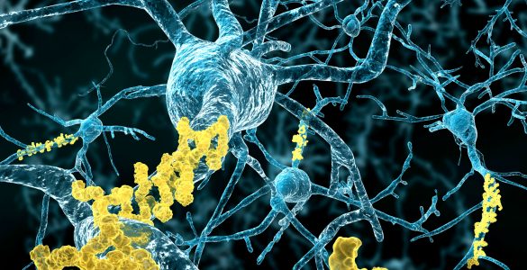 Alzheimer Krankheit