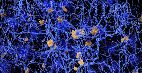 Amyloid-Plaques