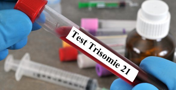 Trisonomie 21