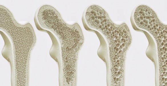 Osteoporose