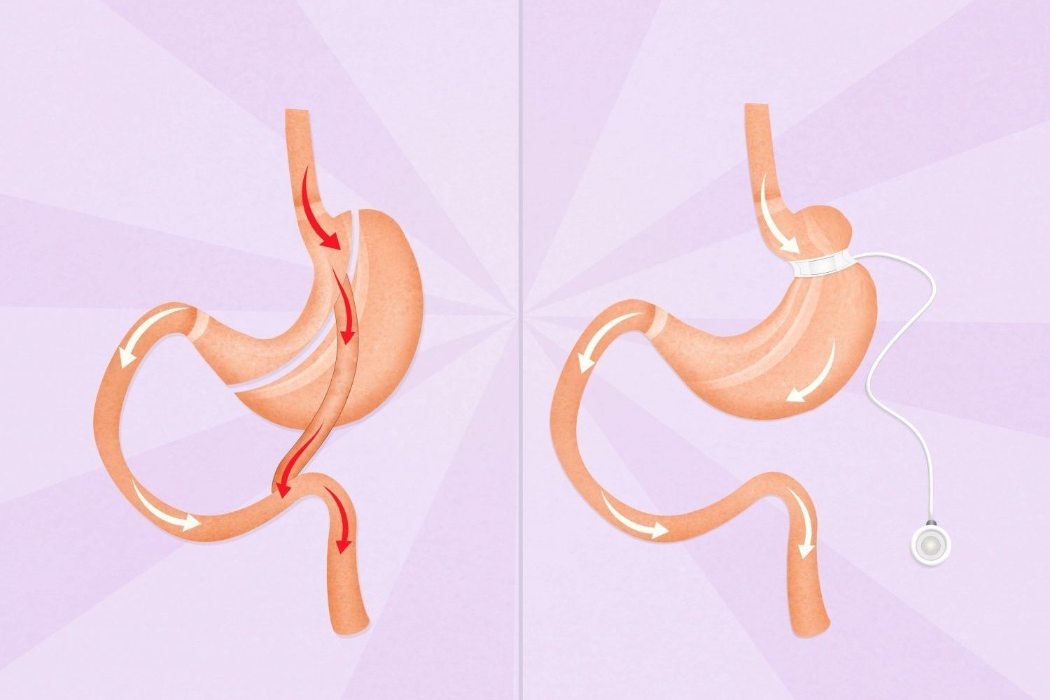 Шунтирование желудка это. Мини желудочное шунтирование. Шунтирование желудка схема операции. Желудочное шунтирование схема операции. Бариатрическая шунтирование желудка.